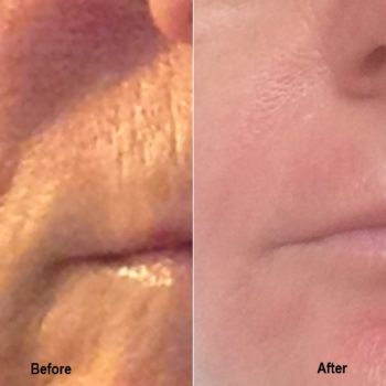 Jessner Peel - Before & After Pictures