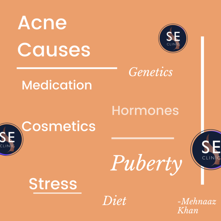 Common Causes of Acne - Skin Essential Clinic