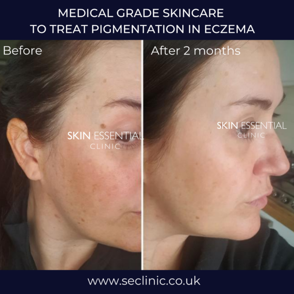 Treating Pigmentation in Eczema - Skin Essential Clinic