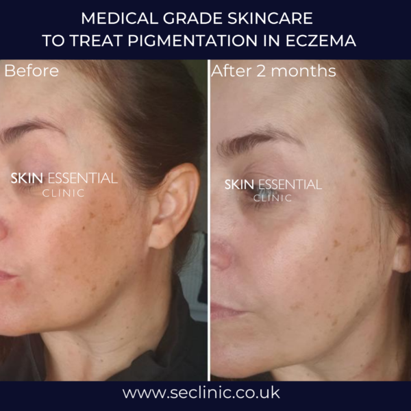 Treating Pigmentation In Eczema Skin Essential Clinic